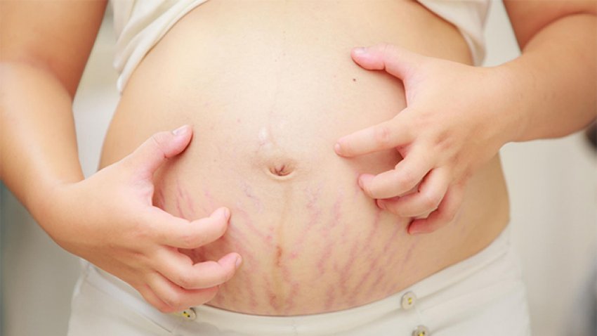 Truqe për të larguar shenjat që mbeten në bark pas lindjes
