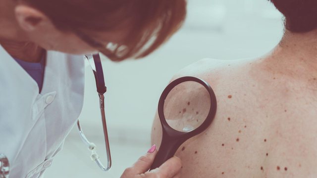 5 rregullat që ndjekin dermatologët për të zbuluar shenjat paralajmëruese të kancerit të lëkurës