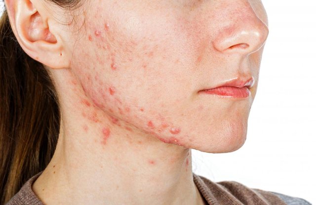Shpëtoni nga puçrrat e kuqe në mjekër; 3 mënyrat efikase nga dermatologët