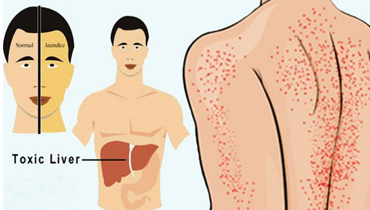 4 shenjat paralajmëruese që tregojnë se mëlçia juaj është e tejmbushur me toksina dhe parazitë