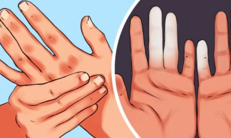 Çfarë do të thotë mpirja e këmbëve dhe e duarve?