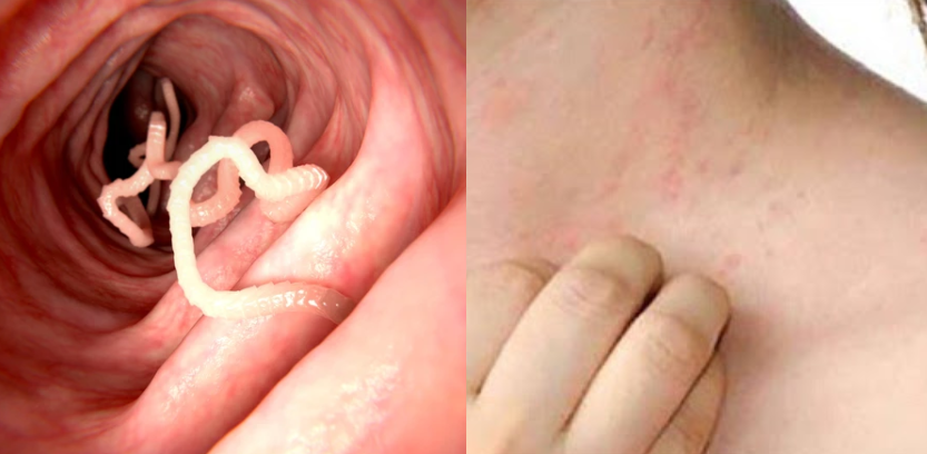 Zhdukni parazitët e përhapur në trupin tuaj me këto metoda shtëpiake, do shpëtoni përgjithmonë