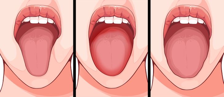 6 gjërat që gjuha juaj mund të zbulojë në lidhje me shëndetin