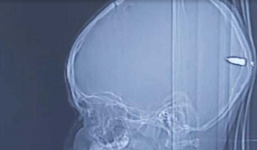 Djali papritmas bëhet i përgjumur, mjekët gjetën diçka të tmerrshme në kokën e tij