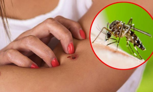 Katër mënyra natyrale për të mbajtur mushkonjat larg trupit tuaj