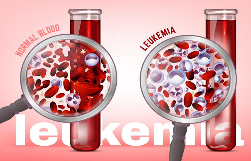 Si ndikon kanceri i gjakut në trupin e njeriut dhe si ta kurojmë?