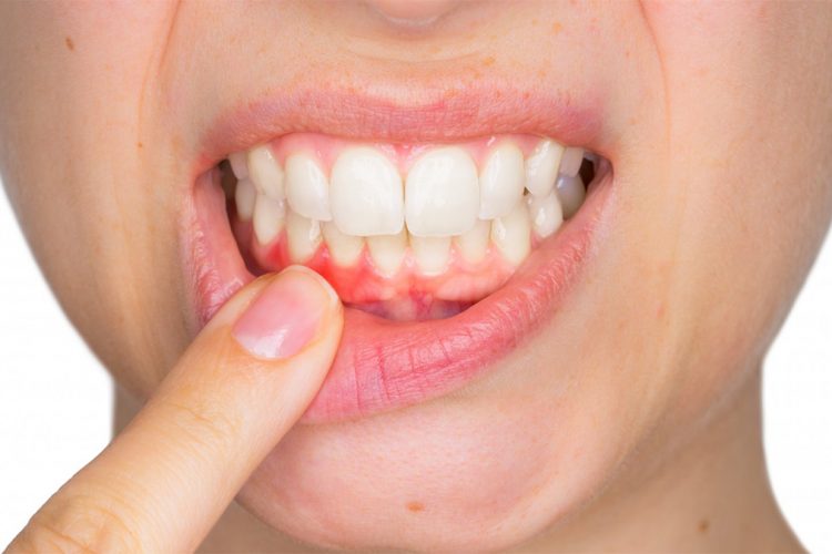 Sëmundja që shkakton rënien e dhëmbëve – Çfarë duhet të bëni