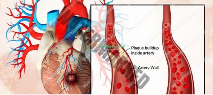 Simptomat që zbulojnë nëse keni arteriet e bllokuara