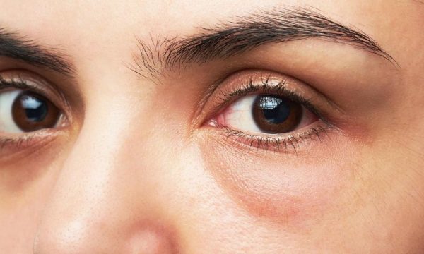 Çfarë e shkakton ënjtjen e syve?