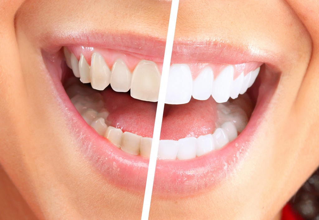 6 gabime të përditshme që s’ju lejojnë të keni dhëmbë të bardhë