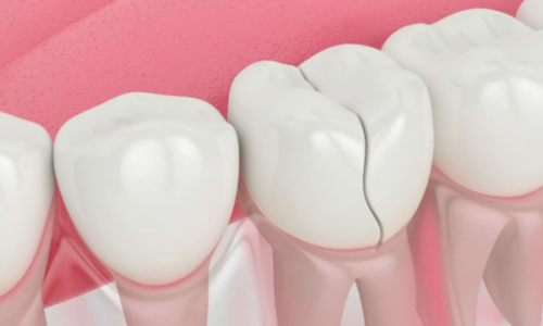 Disa nga komplikimet e një dhëmbi të plasaritur, si ta parandaloni