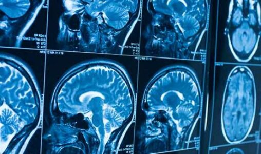 Nëntë simptomat më të zakonshme të tumorit të trurit
