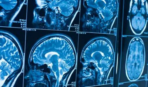 Nëntë simptomat më të zakonshme të tumorit të trurit