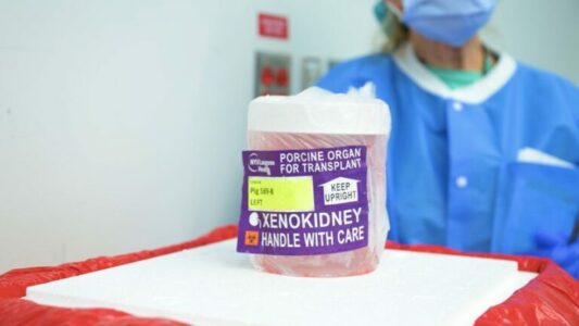 Kirurgët kryejnë transplantin e parë të kombinuar të pompës së zemrës dhe veshkës së derrit