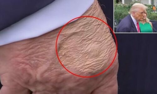 Disa shenja shfaqen në dorën e Trumpit, ekspertët zbulojnë se çfarë janë ato në të vërtetë