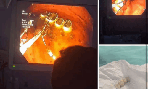 Mjeku nxjerr protezën e dhëmbëve nga lukthi i një pacienti në Pejë