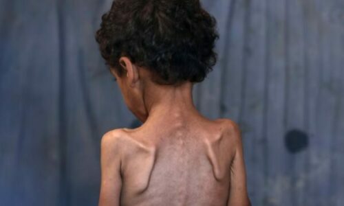 Fëmijët e Gazës po vdesin urie – çfarë i bën kequshqyerja trupit të njeriut?