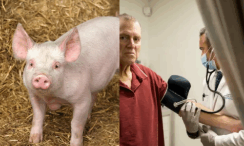 Pas rekordit prej 271 ditësh, amerikanit i hiqet veshka e derrit