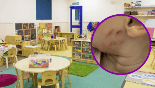 “Shenja thonjsh në fyt”, flet daja i njëvjeçares që dyshohet se u lëndua nga edukatorja në çerdhe