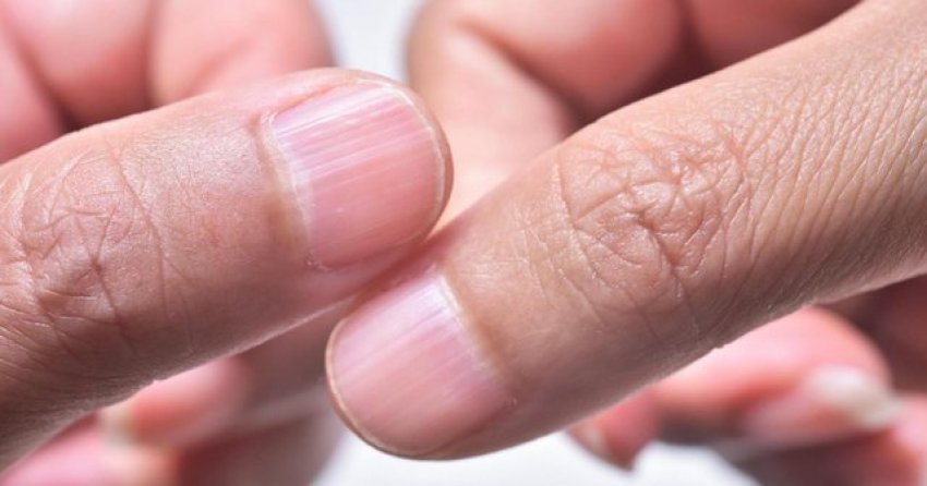 ndryshimet-ne-thonjte-tuaj-mund-te-tregojne-probleme-serioze-shendetesore-reagoni-ne-kohe