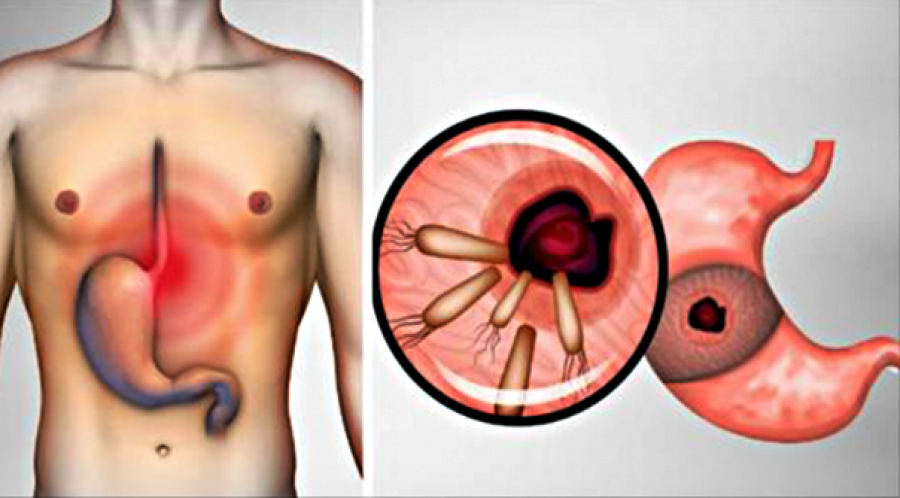 vetem-keshtu-mund-te-largohet-helikobakteri-nga-trupi