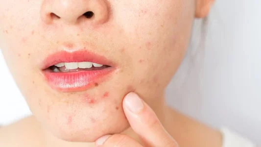 Sheqeri dhe bylmeti: Armiqtë e fshehur të lëkurës tuaj