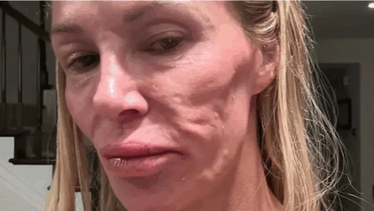 Ish-modelja tregon si i shpërthyen implantet e gjoksit dhe i shpërfytyruan fytyrën: U plaka 20 vite brenda natës